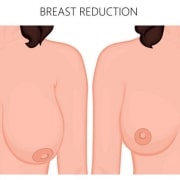 عملية تصغير الثدي