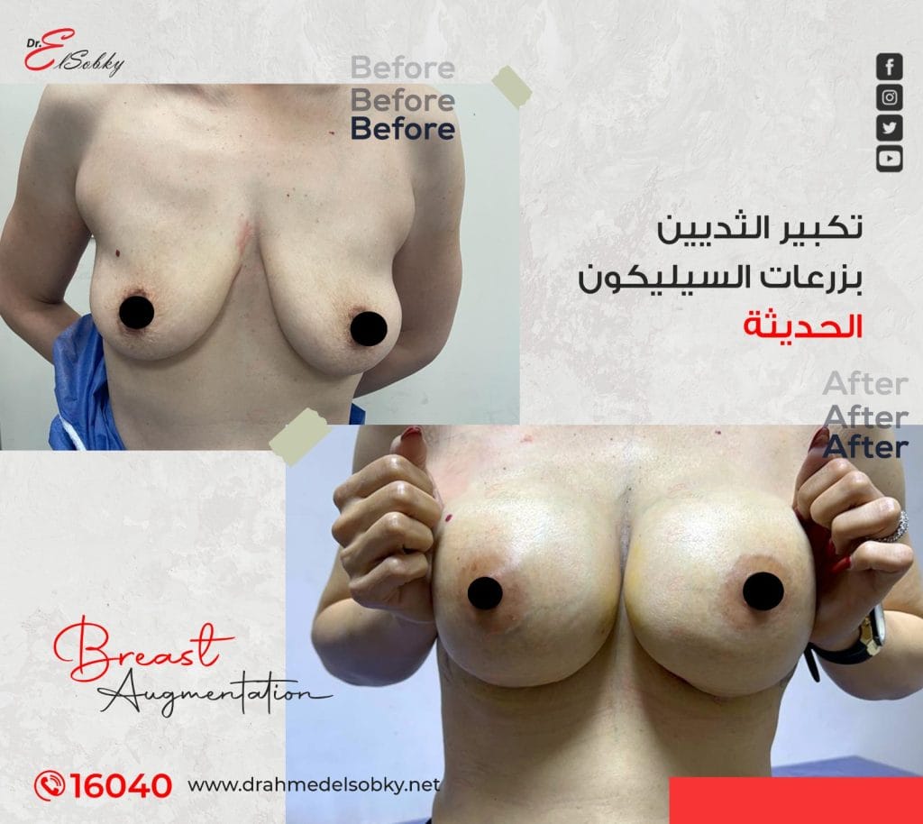تكبير الثديين بزرعات السيلكون