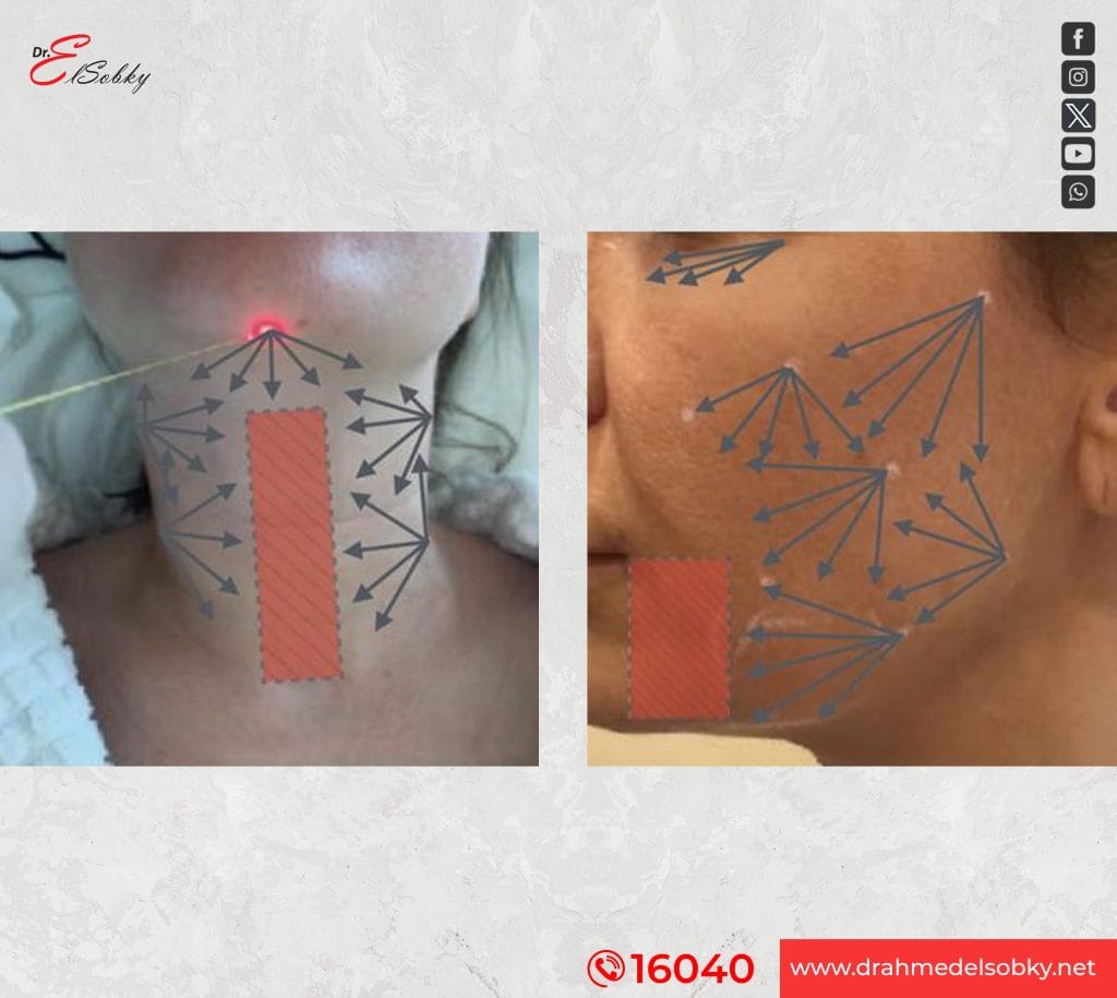 كيفية-عمل-endolift